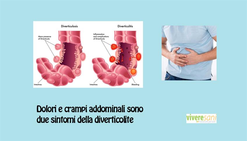 Conosciamo i diverticoli Conosciamo i diverticoli